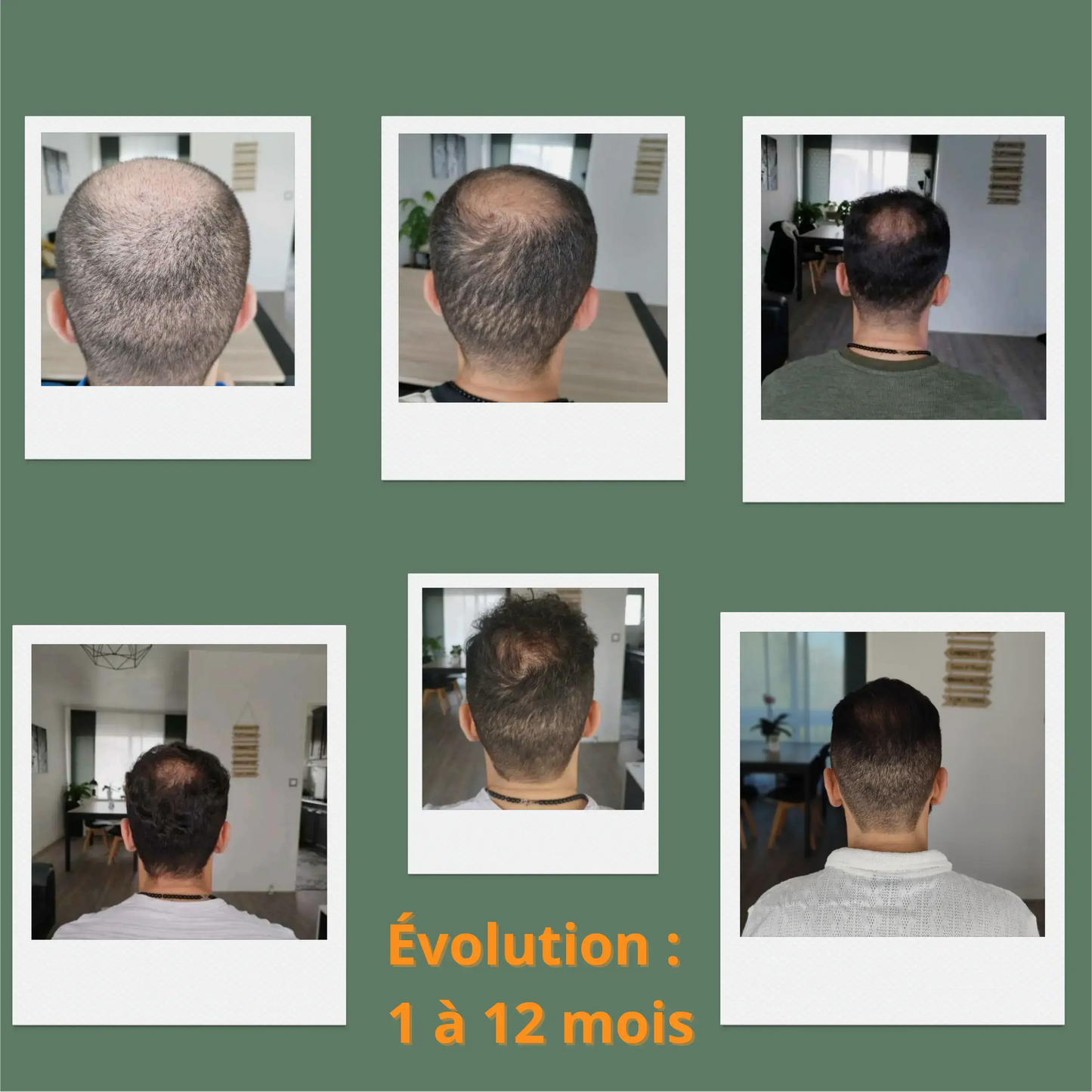 Avant-après greffe capillaire : évolution des résultats de repousse de cheveux de 1 à 12 mois avec le Pack Kalaboost.
