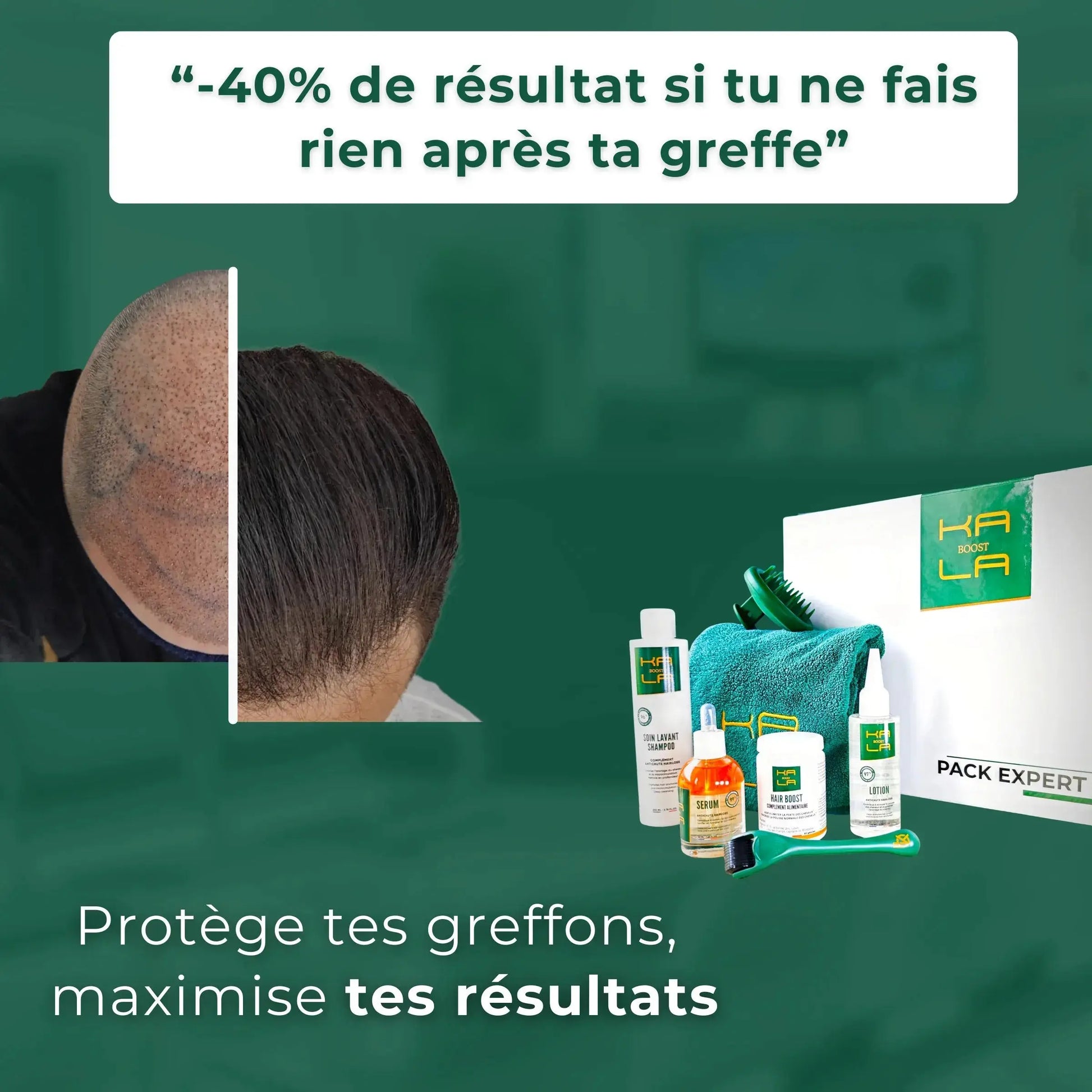 Pack Expert Repousse – Soin expert greffe capillaire KALABOOST